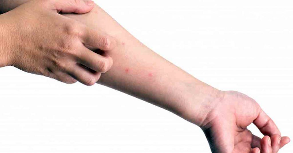 Aquí tienes remedios caseros para picaduras de mosquitos