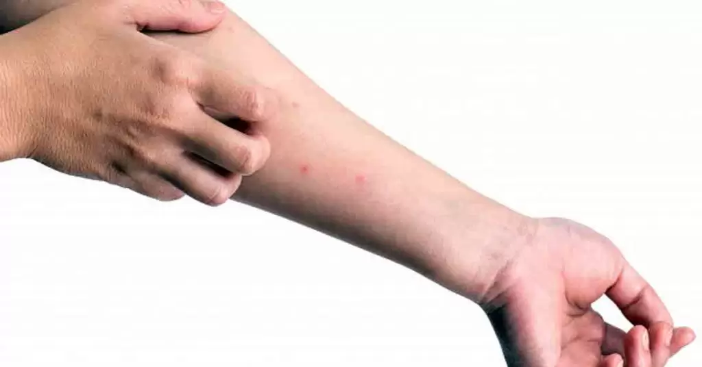 Aquí tienes remedios caseros para picaduras de mosquitos